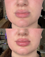 Lip Enhancer