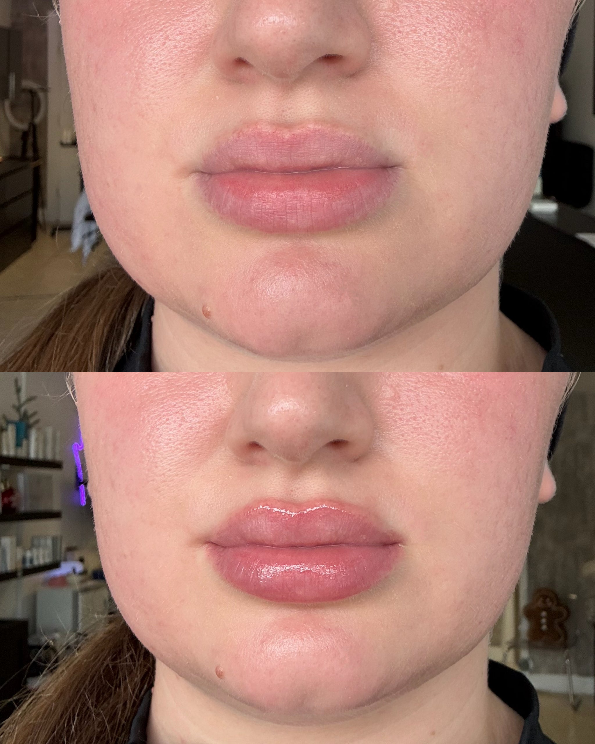 Lip Enhancer